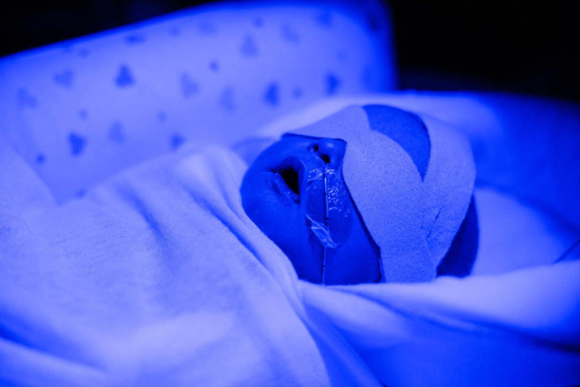 A newborn baby receive UV Treatment for jaundice