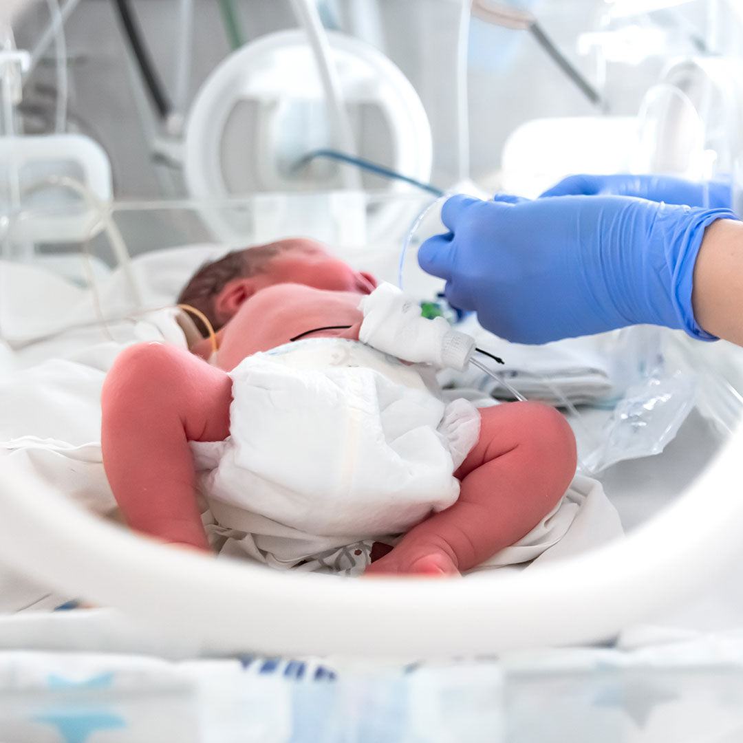 A baby being treated in a Neonatal Unit on a respirator